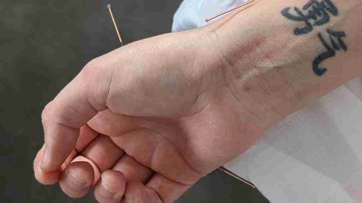 Acupuncture Therapy Benefits