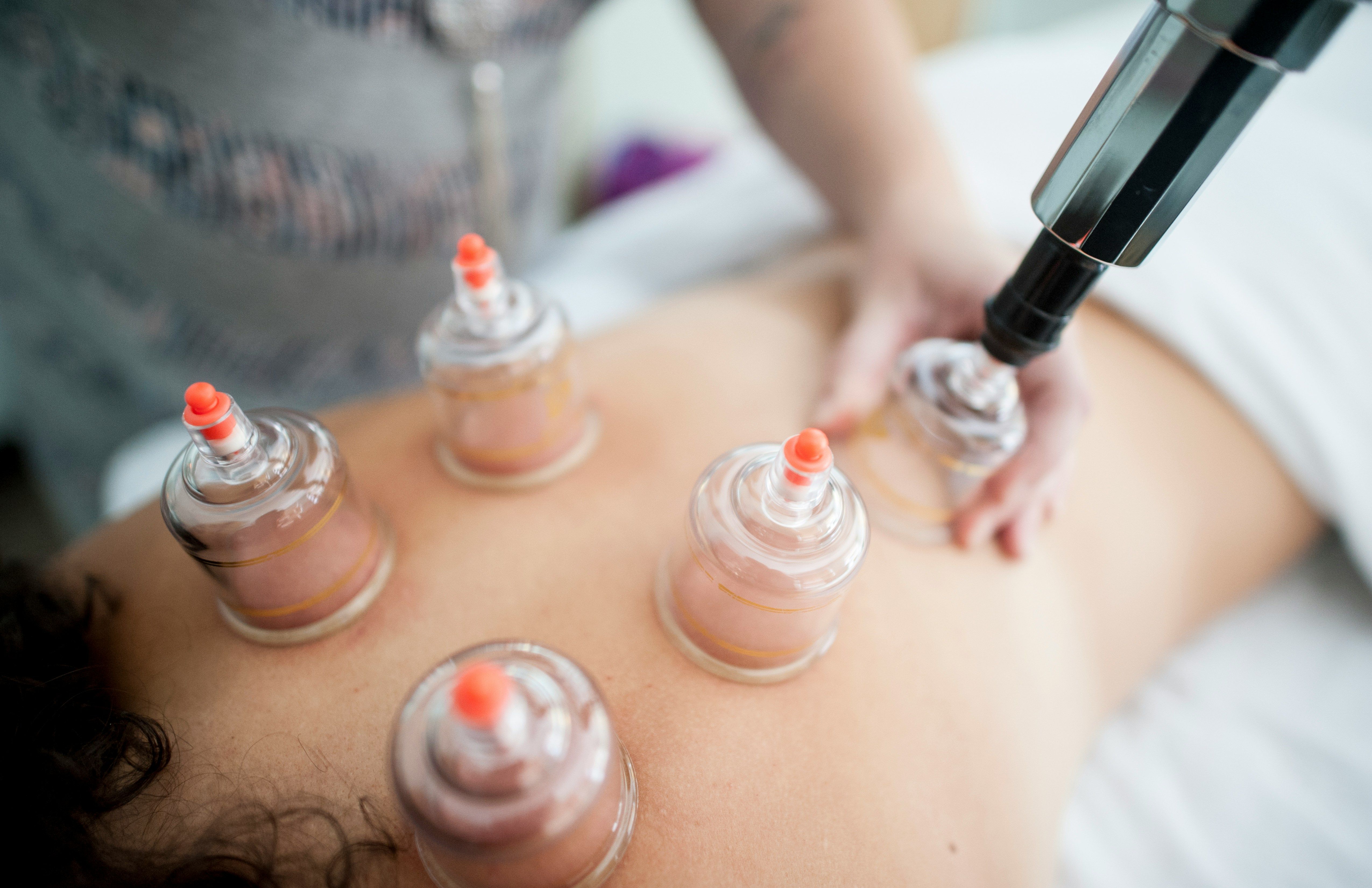 a woman is getting a cupping treatment on her back .