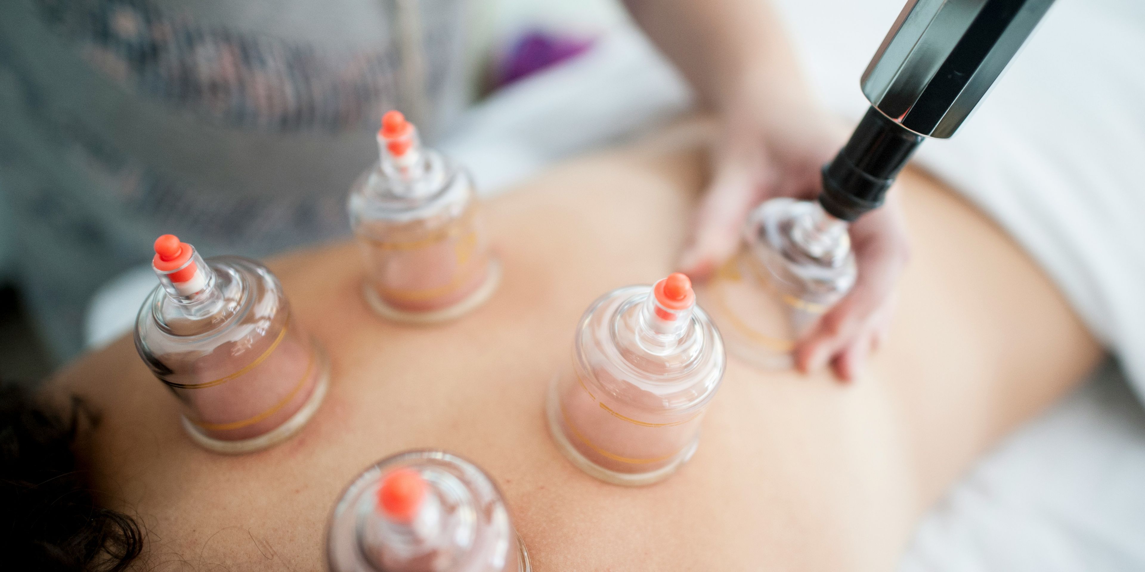 a woman is getting a cupping treatment on her back .