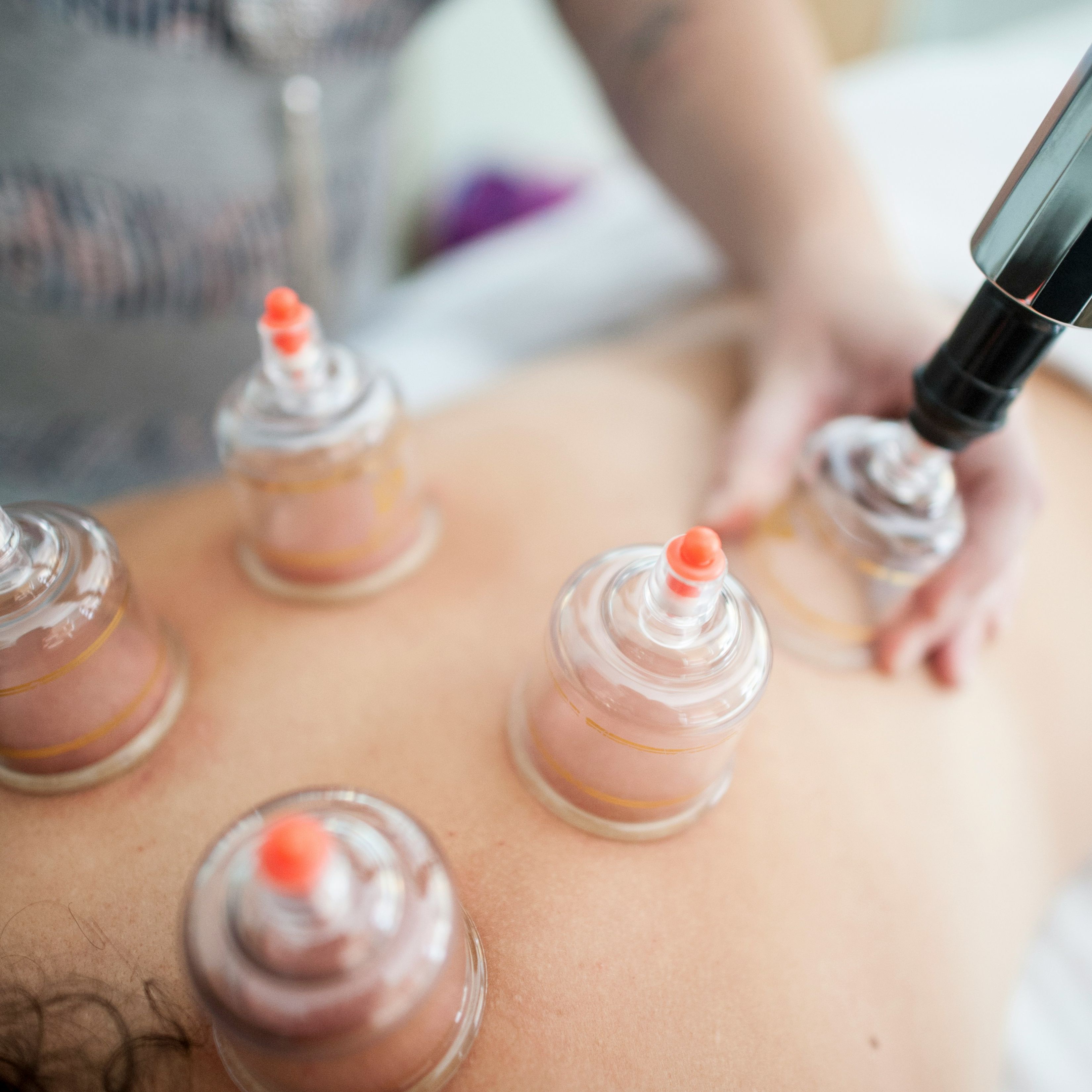 a woman is getting a cupping treatment on her back .