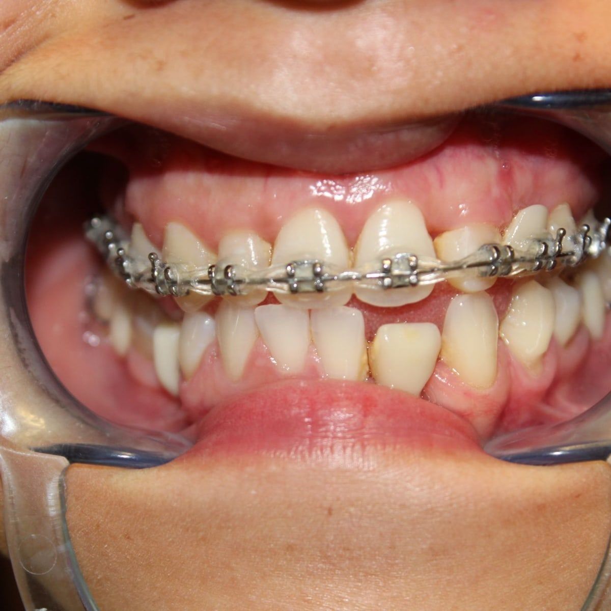 Clinical photograph, Overcoming a Complex Case of a Bilateral Crossbite