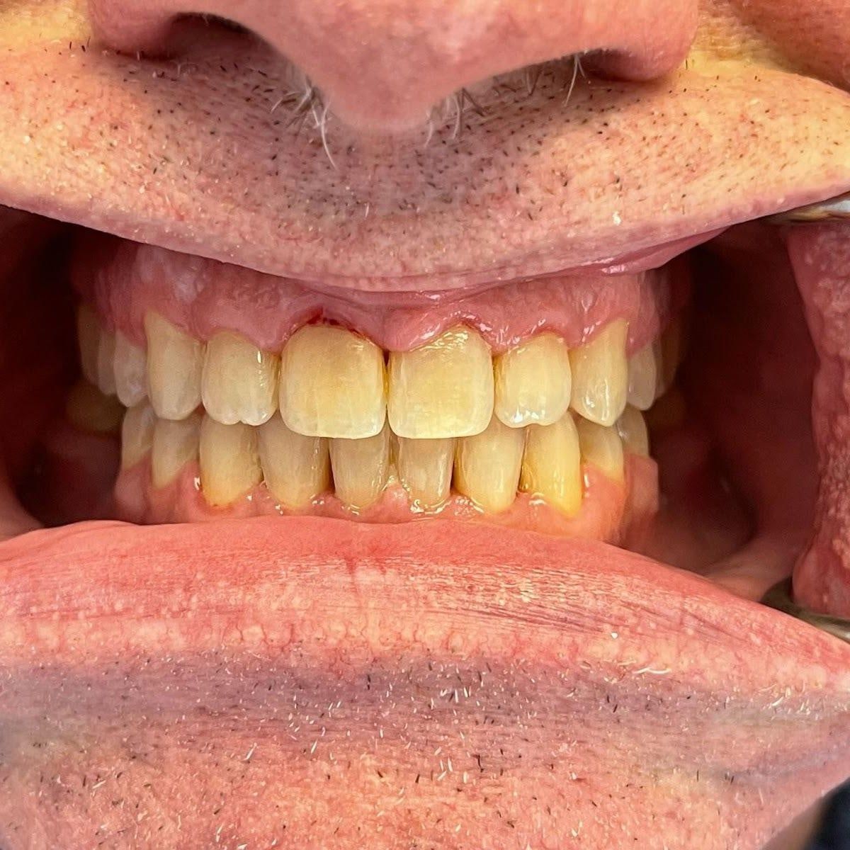 Clinical photograph, Understanding and Addressing Lower Front Teeth Spacing: The Case of a Protrusive Occlusion