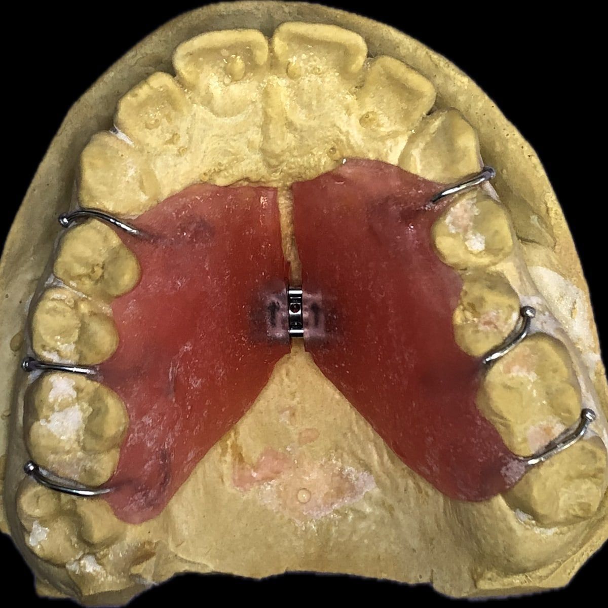 Clinical photograph, Overcoming a Complex Case of a Bilateral Crossbite