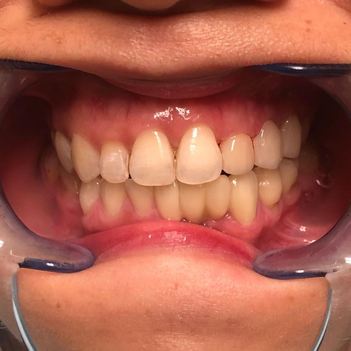 Clinical photograph, Overcoming a Complex Case of a Bilateral Crossbite