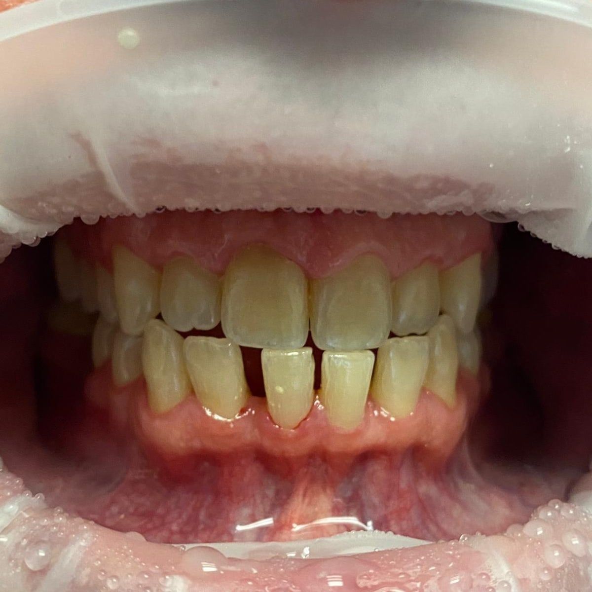 Clinical photograph, Understanding and Addressing Lower Front Teeth Spacing: The Case of a Protrusive Occlusion