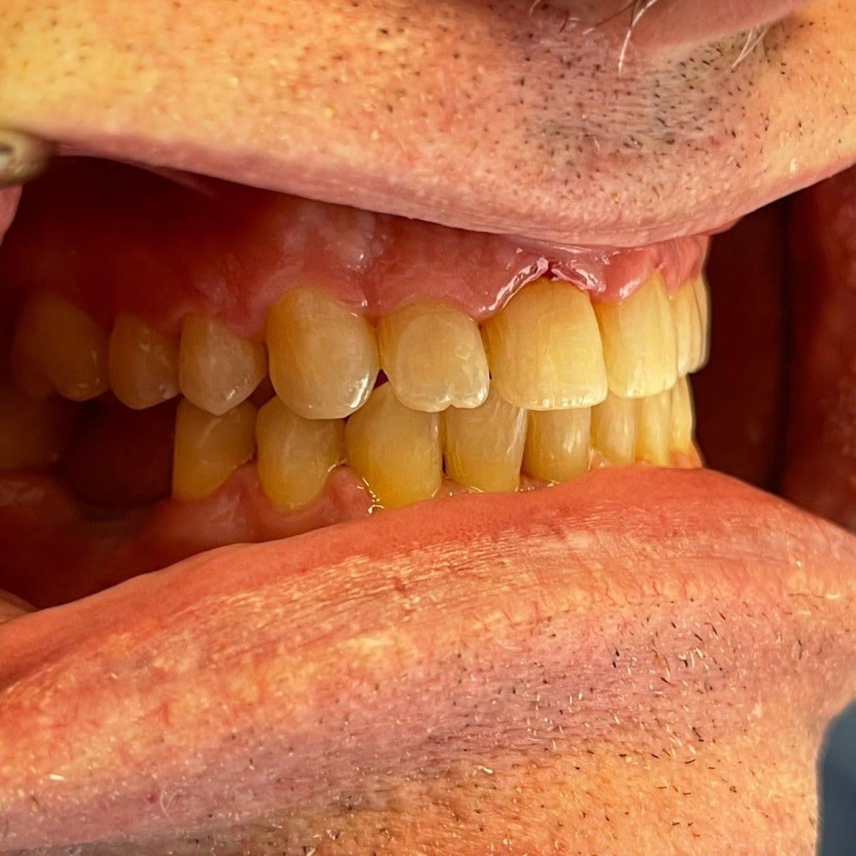 Clinical photograph, Understanding and Addressing Lower Front Teeth Spacing: The Case of a Protrusive Occlusion