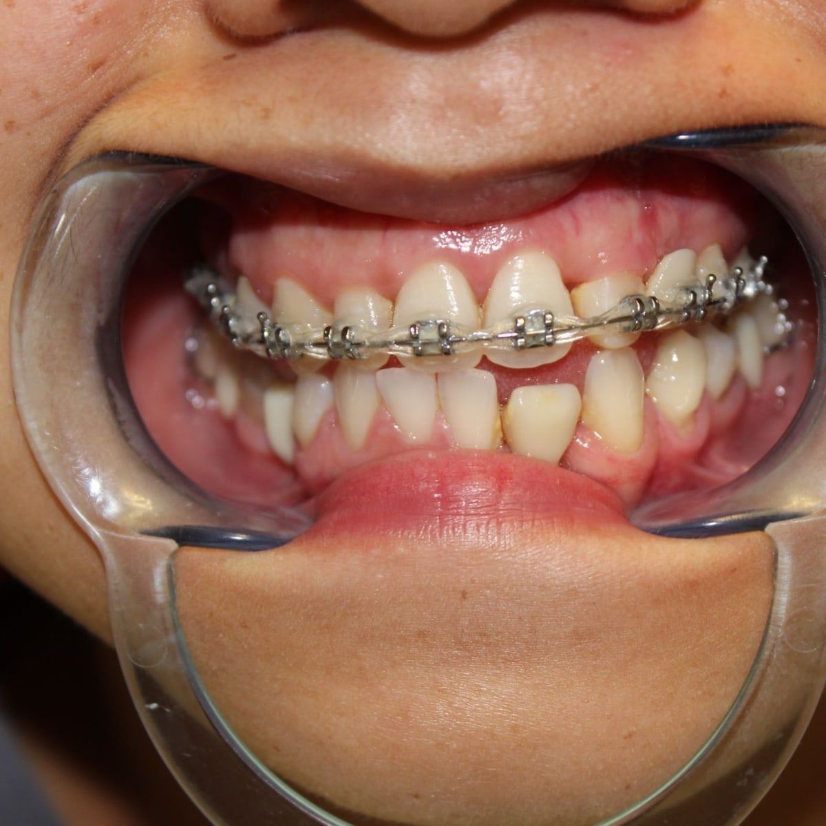 Clinical photograph, Overcoming a Complex Case of a Bilateral Crossbite