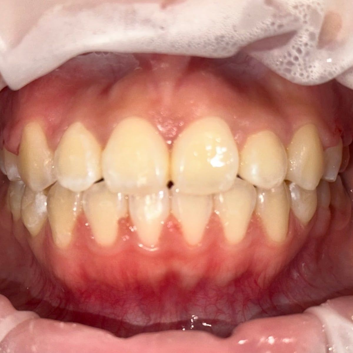 Clinical photograph, Why Expanding the Arch Trumps Extractions for Lifelong TMJ Health