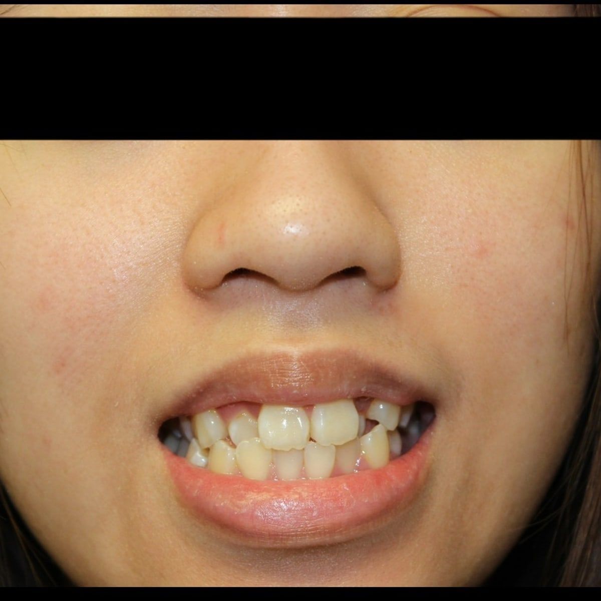 Clinical photograph, Why Expanding the Arch Trumps Extractions for Lifelong TMJ Health