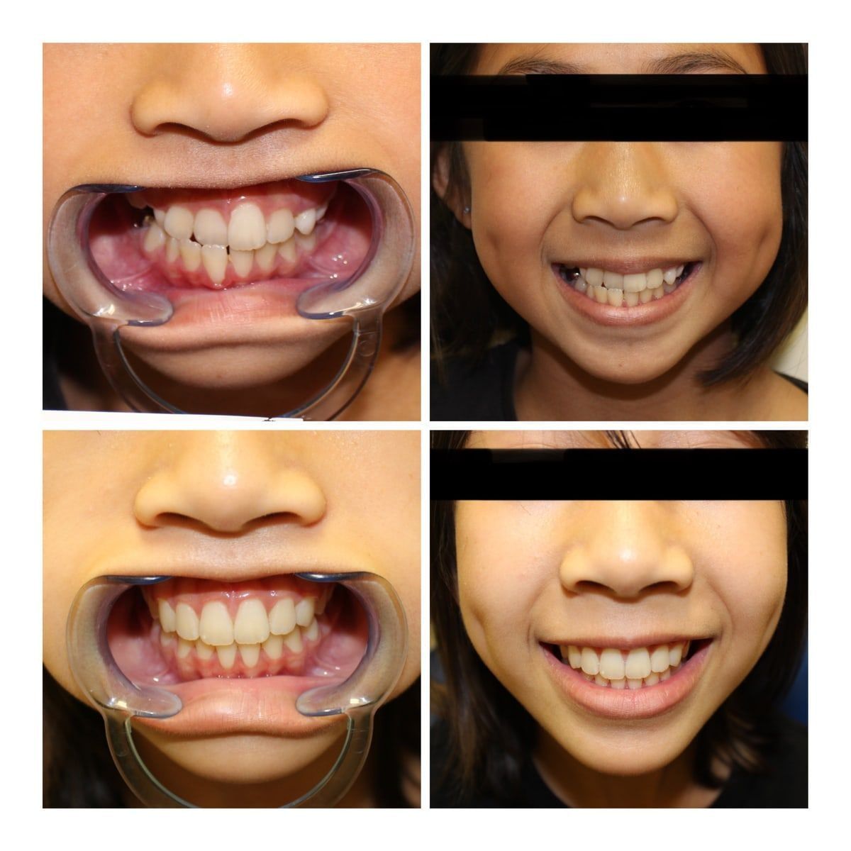 Clinical photograph, Transforming Pediatric Orthodontics: A Comprehensive Approach to a Complex Case