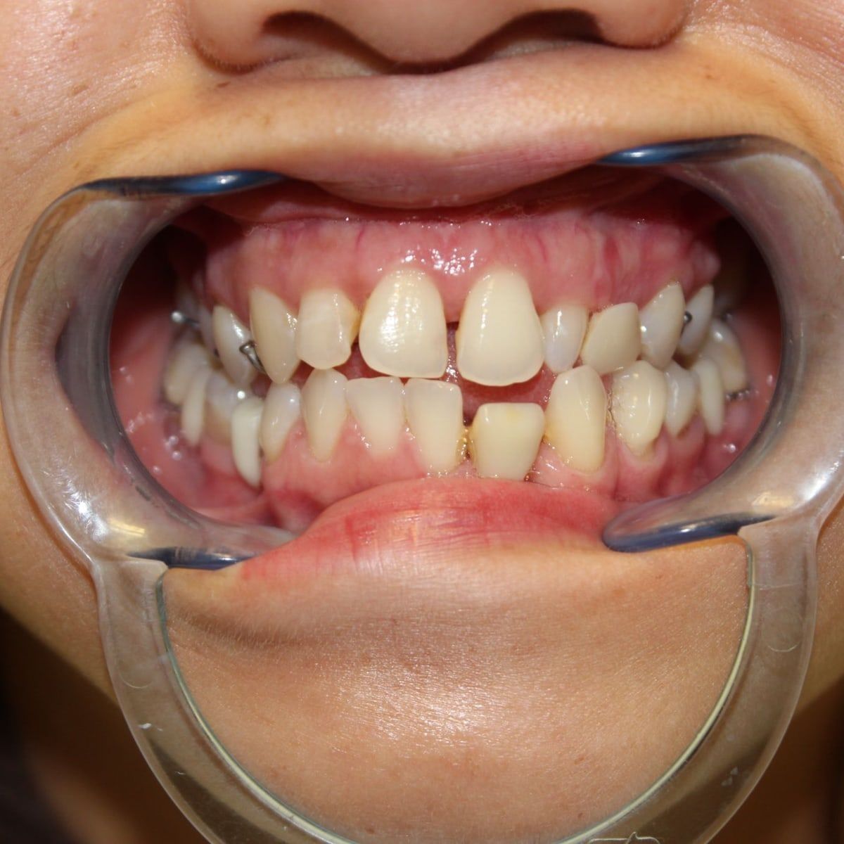 Clinical photograph, Overcoming a Complex Case of a Bilateral Crossbite