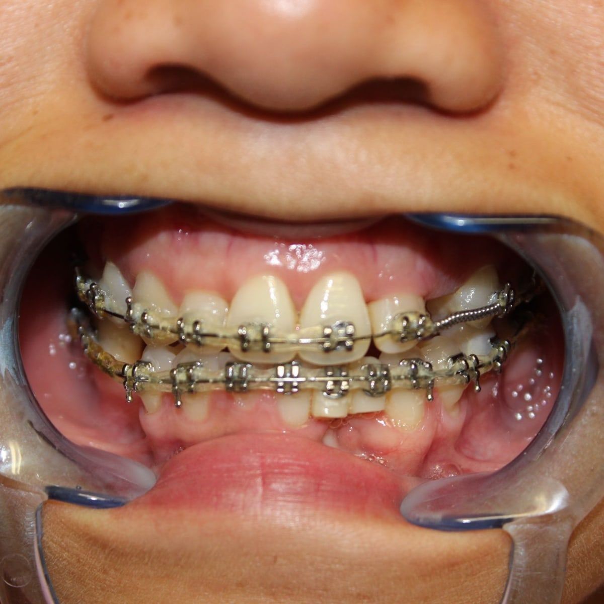 Clinical photograph, Overcoming a Complex Case of a Bilateral Crossbite