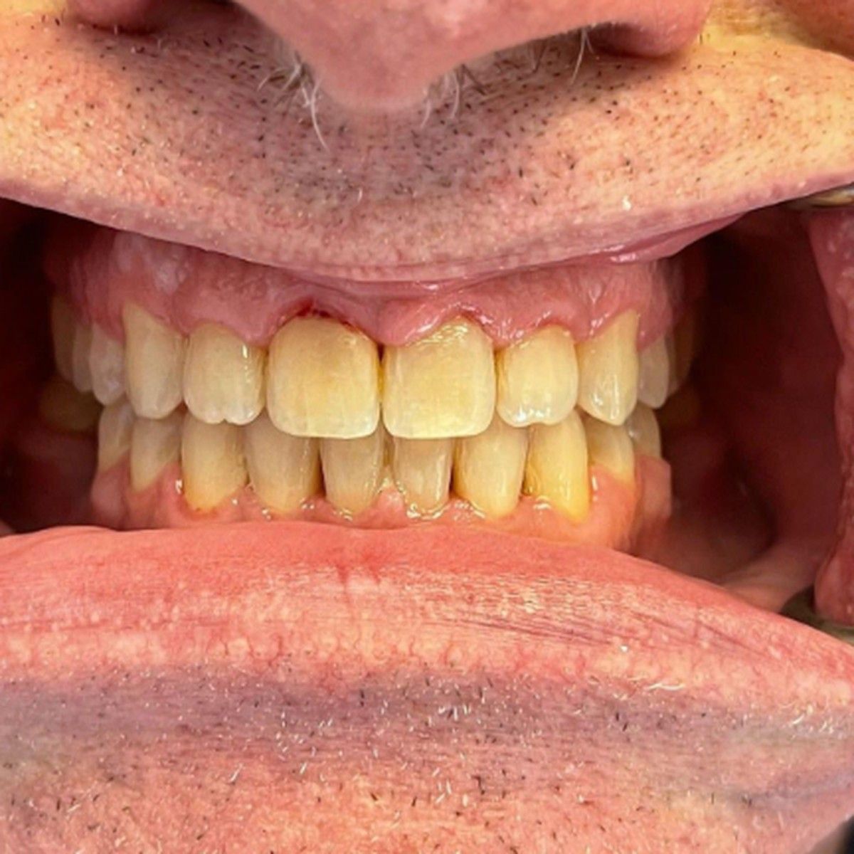 After Understanding and Addressing Lower Front Teeth Spacing: The Case of a Protrusive Occlusion