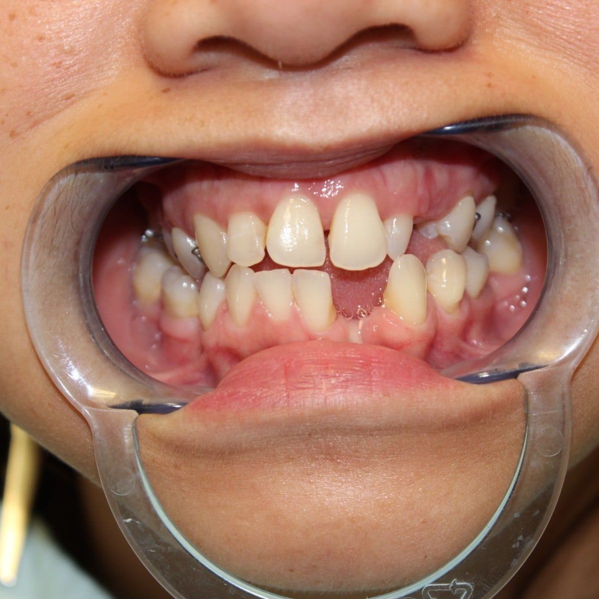 Clinical photograph, Overcoming a Complex Case of a Bilateral Crossbite