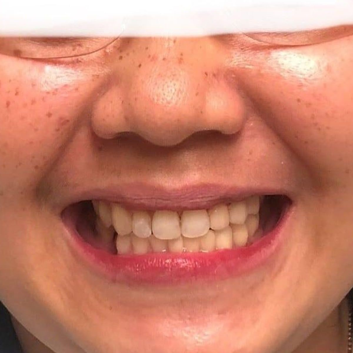 Clinical photograph, Overcoming a Complex Case of a Bilateral Crossbite