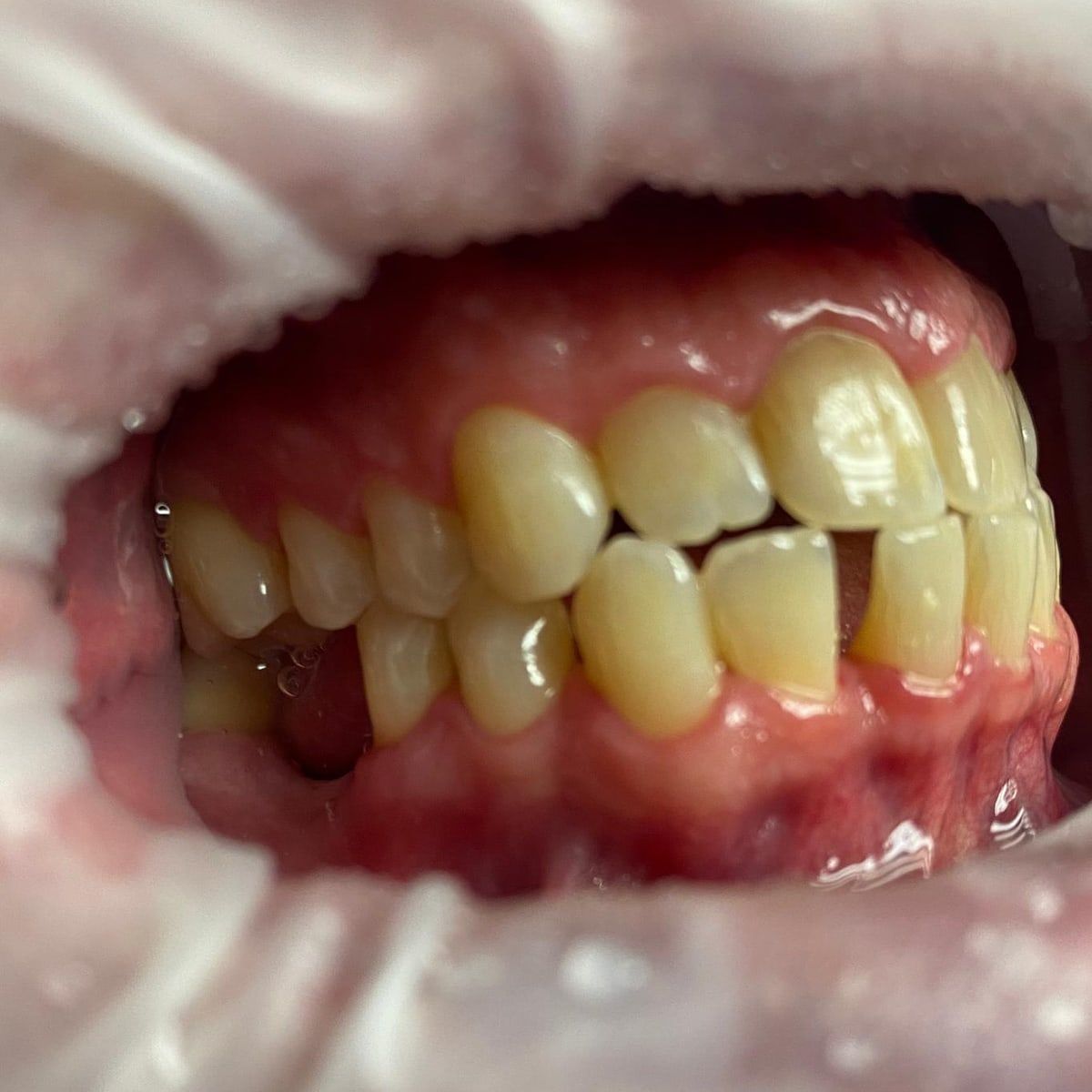 Clinical photograph, Understanding and Addressing Lower Front Teeth Spacing: The Case of a Protrusive Occlusion