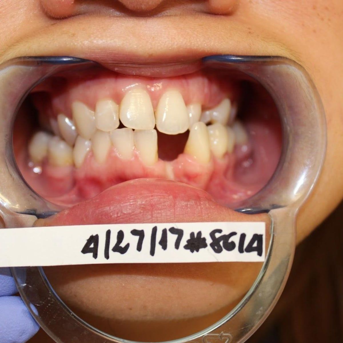 Clinical photograph, Overcoming a Complex Case of a Bilateral Crossbite