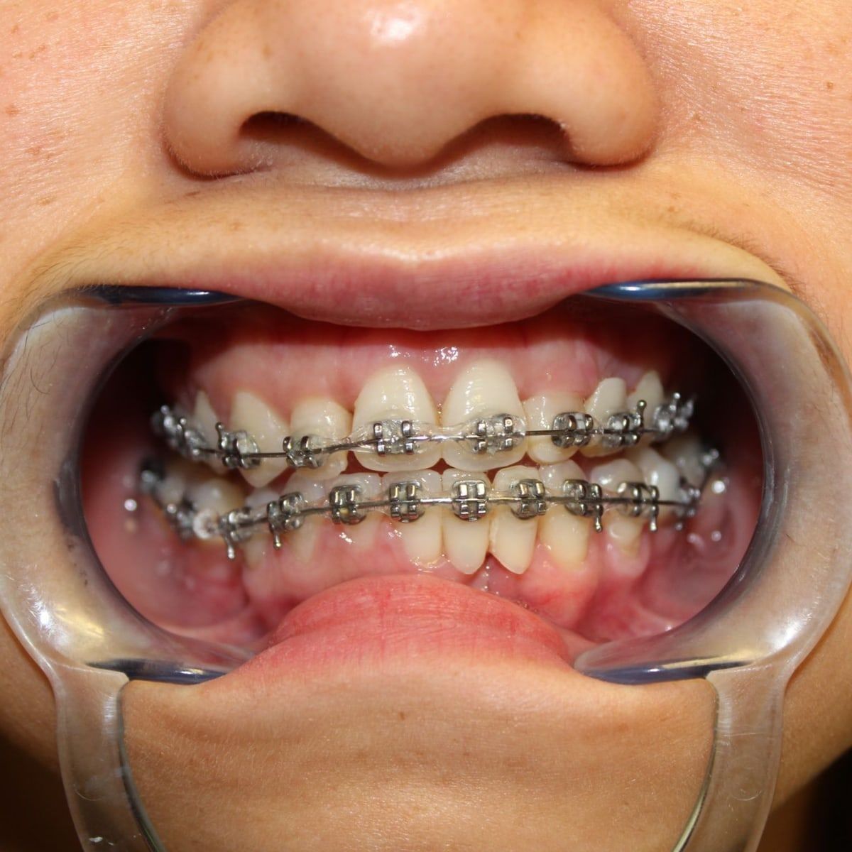Clinical photograph, Overcoming a Complex Case of a Bilateral Crossbite