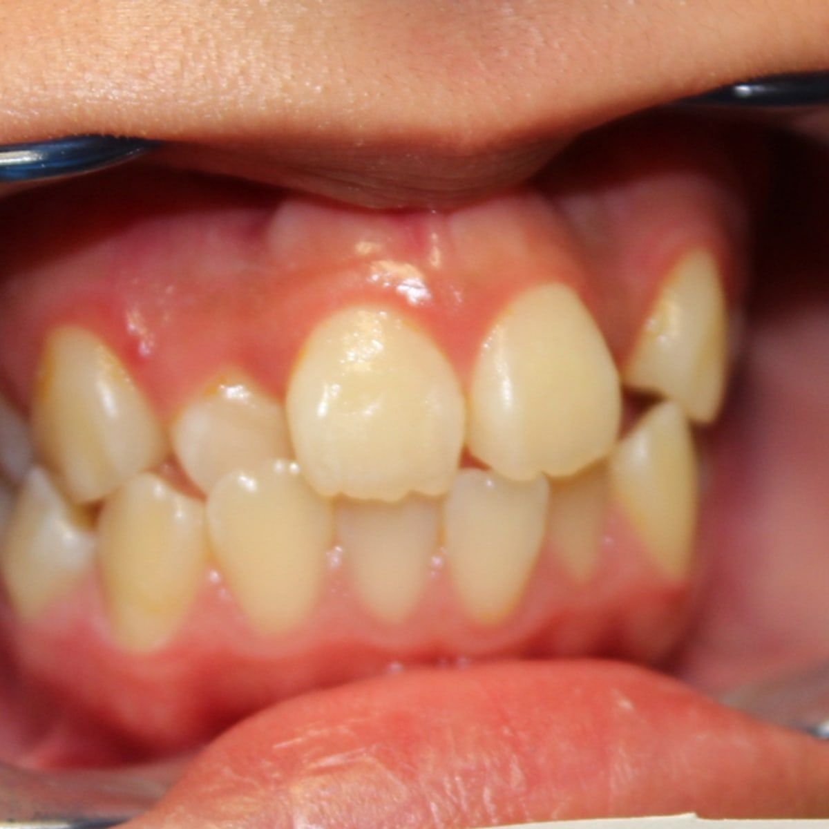 Clinical photograph, Why Expanding the Arch Trumps Extractions for Lifelong TMJ Health