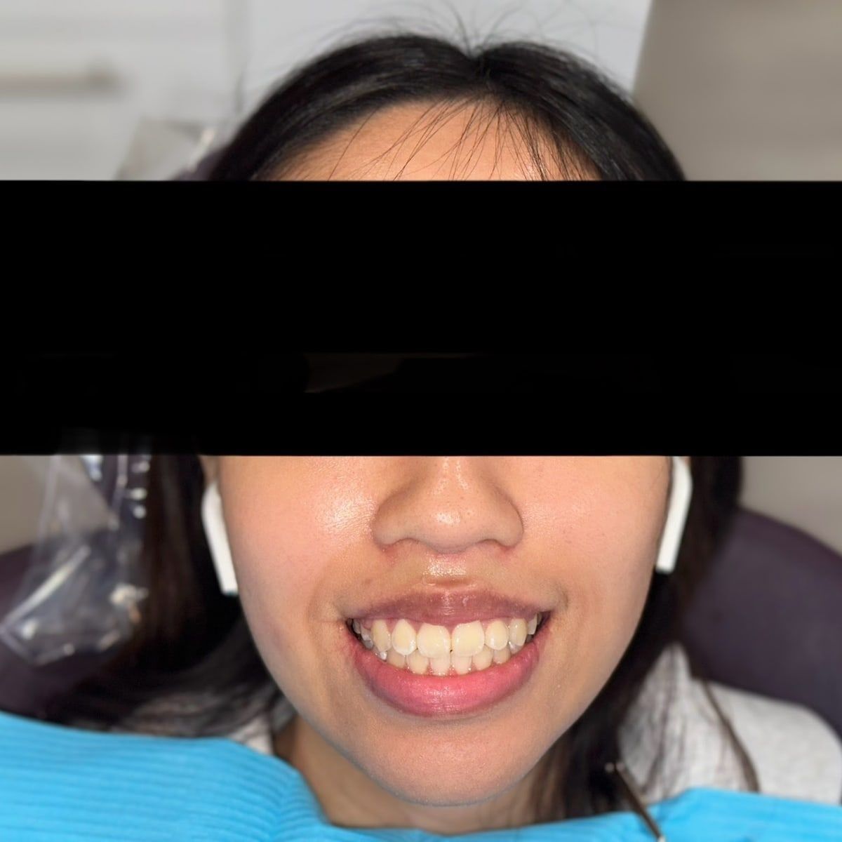 Clinical photograph, Why Expanding the Arch Trumps Extractions for Lifelong TMJ Health