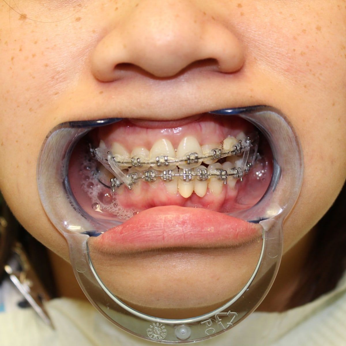 Clinical photograph, Overcoming a Complex Case of a Bilateral Crossbite