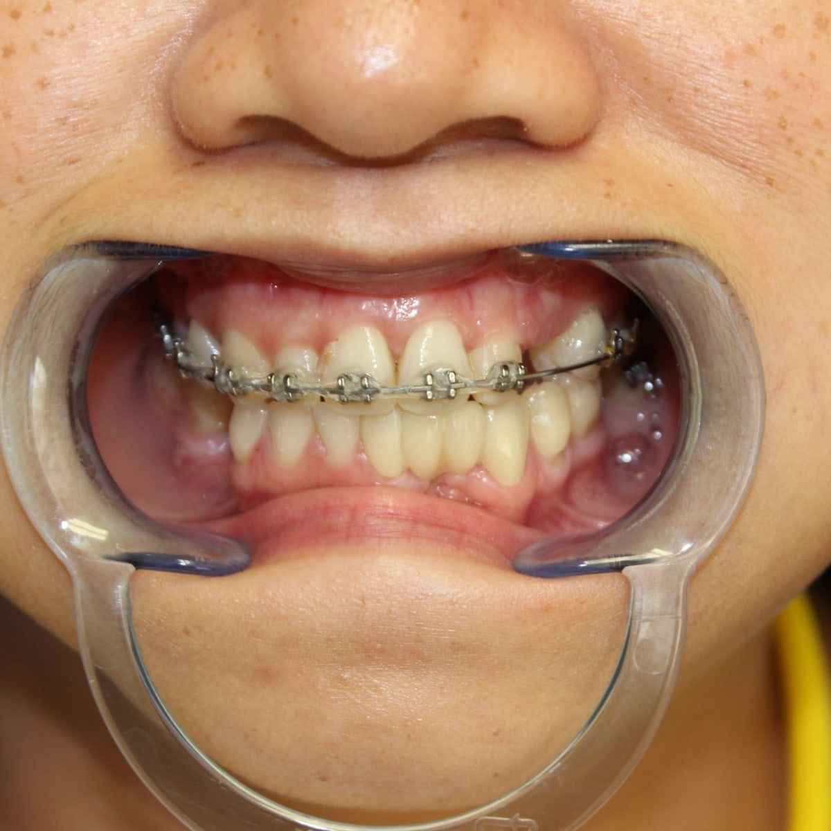 Clinical photograph, Overcoming a Complex Case of a Bilateral Crossbite