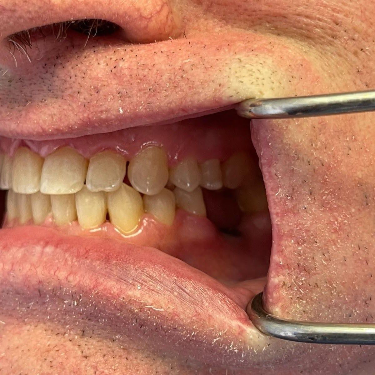 Clinical photograph, Understanding and Addressing Lower Front Teeth Spacing: The Case of a Protrusive Occlusion