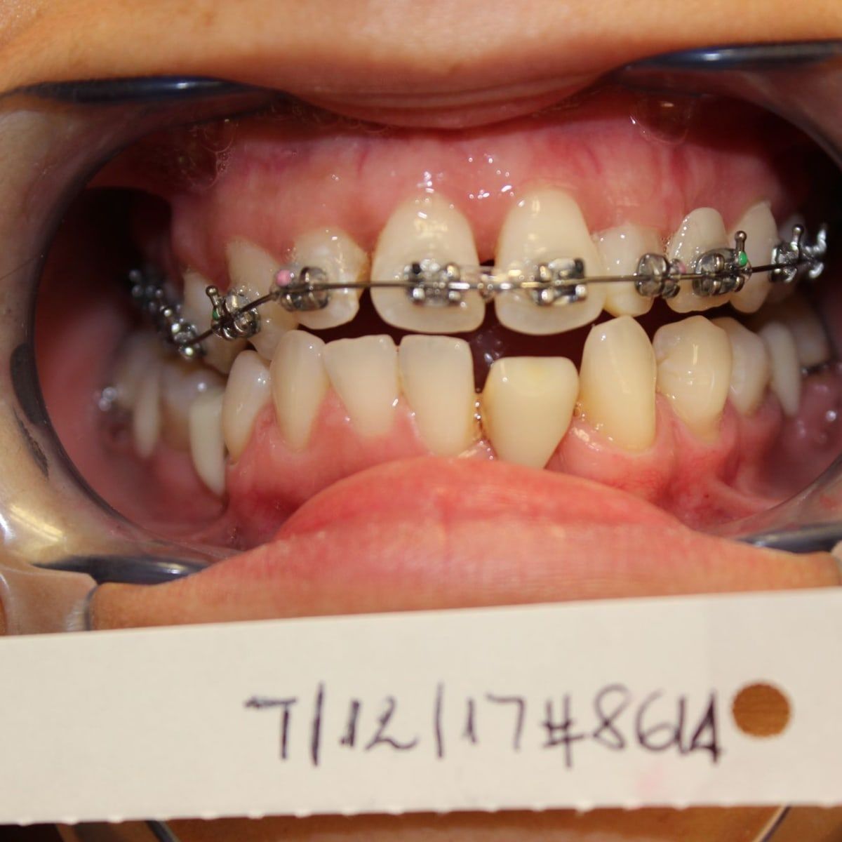 Clinical photograph, Overcoming a Complex Case of a Bilateral Crossbite
