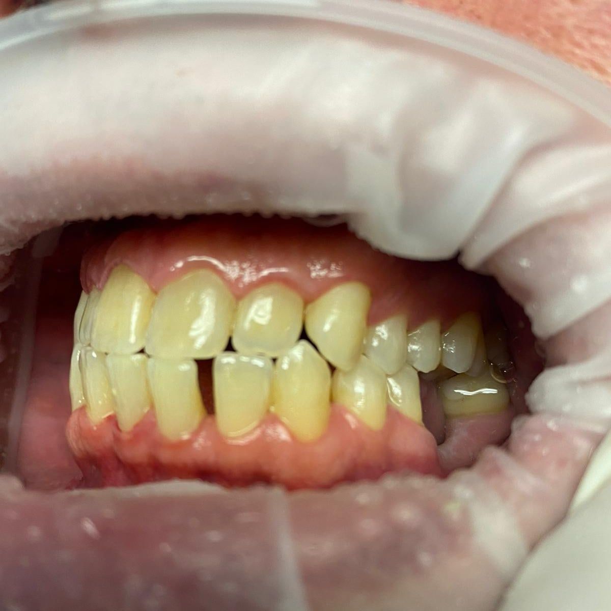 Clinical photograph, Understanding and Addressing Lower Front Teeth Spacing: The Case of a Protrusive Occlusion