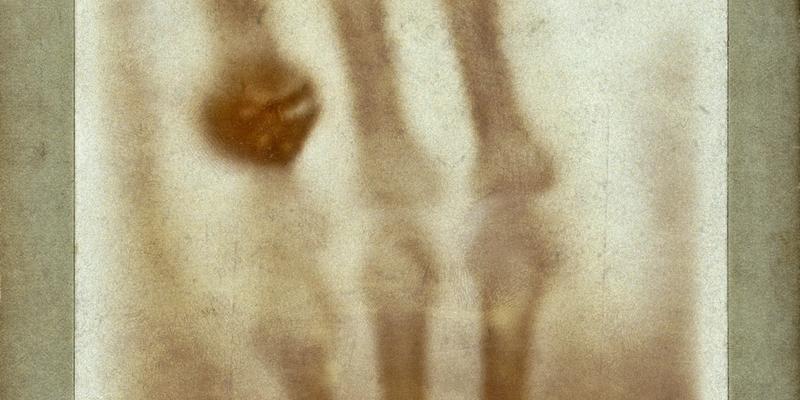 Carbon-nanotube digital X-rays transform the landscape after 130 years