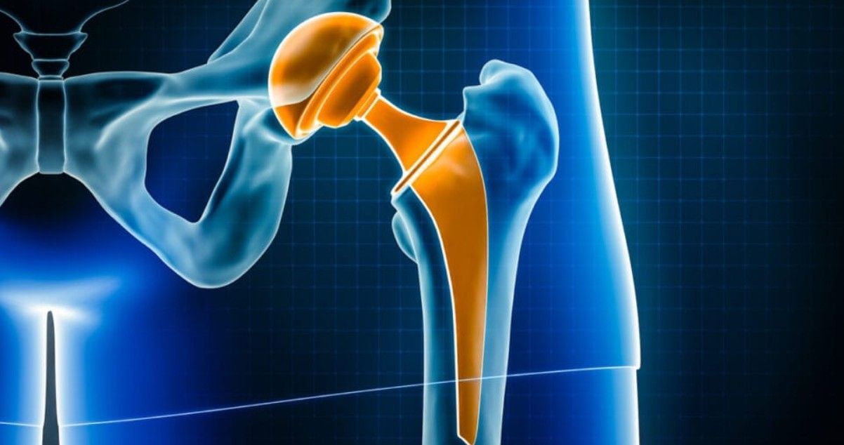 Can Hip Replacement Cause Leg Length Difference?