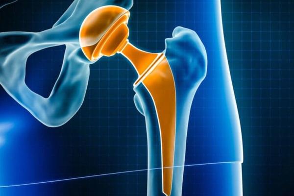 Can Hip Replacement Cause Leg Length Difference? Can Hip Replacement Cause Leg Length Difference?