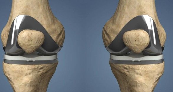 What Are the Types of Knee Replacement?
