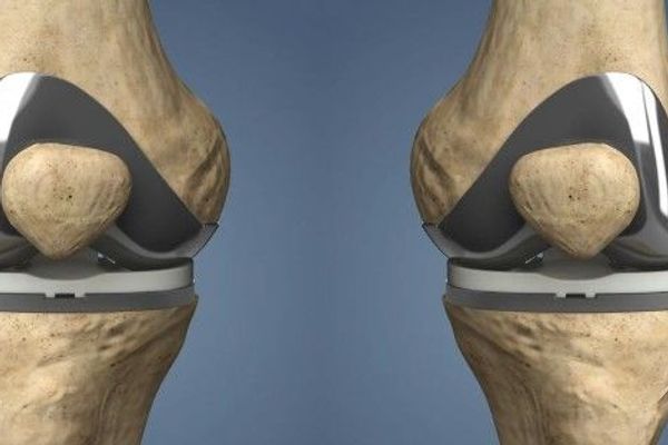 What Are the Types of Knee Replacement? What Are the Types of Knee Replacement?