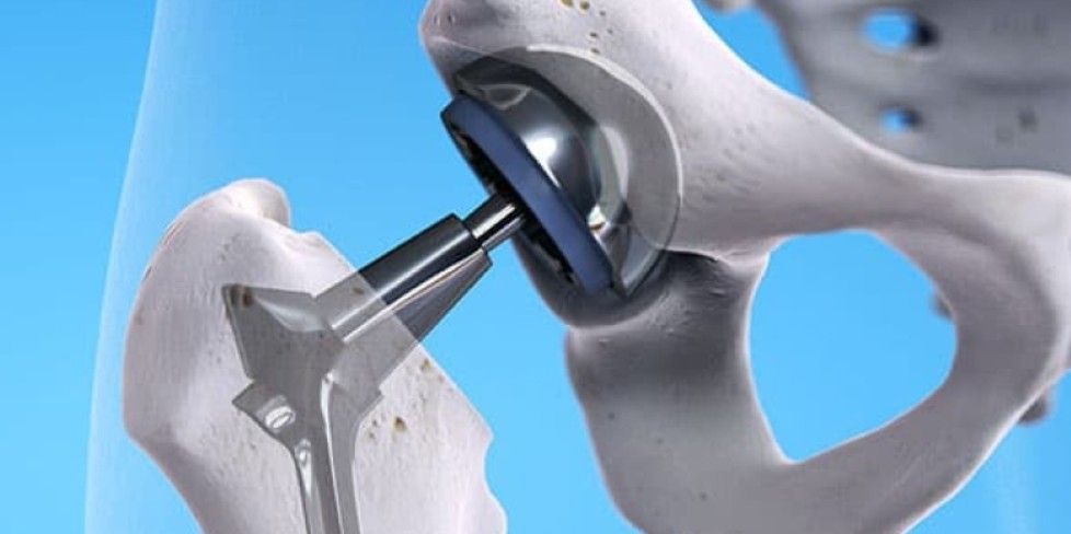 Does a Hip Replacement Change the Way You Walk?