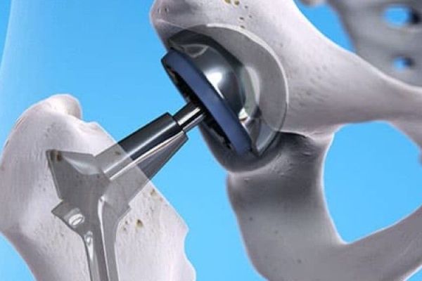 Does a Hip Replacement Change the Way You Walk? Does a Hip Replacement Change the Way You Walk?