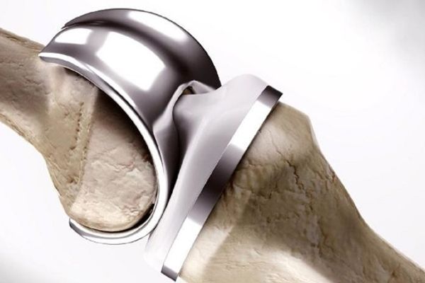 Quels Matériaux Sont Utilisés Dans Une Prothèse De Genou Et Quelle Est Leur Durabilité ? durabilite-des-materiaux-de-la-prothese-du-genou