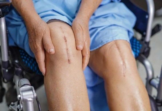 What Is Smart Robotic Knee Replacement?