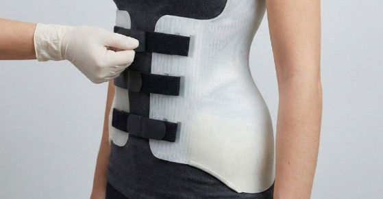 Comment Le Corset Pour La Scoliose Affecte-t-il La Vie Quotidienne ?
