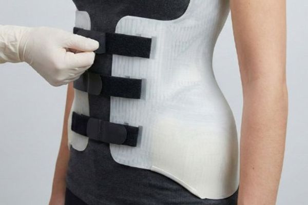 Comment Le Corset Pour La Scoliose Affecte-t-il La Vie Quotidienne ?