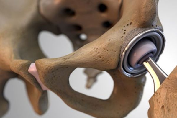 Points À Respecter En Position Assise Après Une Chirurgie De Prothèse De Hanche Points À Respecter En Position Assise Après Une Chirurgie De Prothèse De Hanche