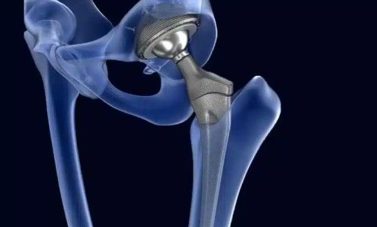 How Long Does Limping Last After a Hip Replacement?