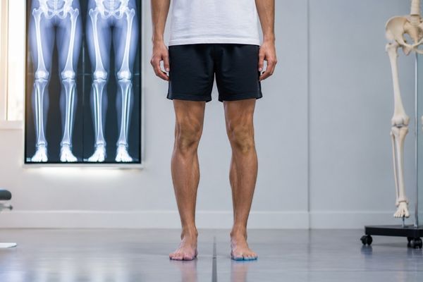 Quel gain de taille après un allongement des membres ? Quel gain de taille après un allongement des membres ?