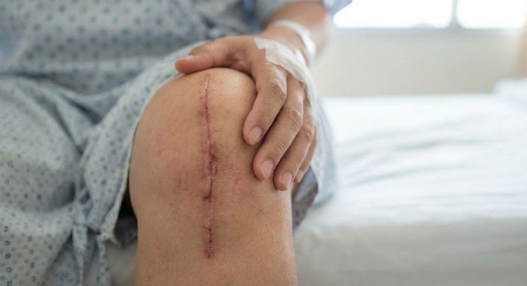 In Which Situations Is a Knee Replacement Necessary?
