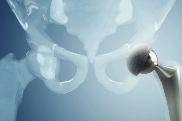 Qu’est-ce qu’une Luxation de Prothèse de Hanche ? Qu’est-ce qu’une Luxation de Prothèse de Hanche ?