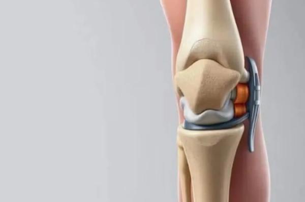 Is Knee Replacement Surgery Risky? Is Knee Replacement Surgery Risky?