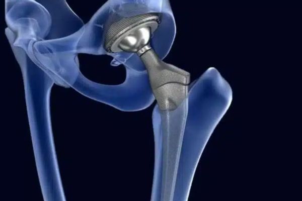 Combien De Temps Boite-t-on Après Une Prothèse De Hanche ? combien-de-temps-boiter-apres-prothese-hanche