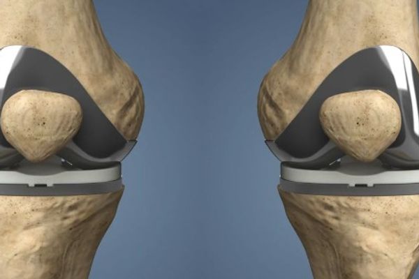 quels-sont-les-types-de-protheses-du-genou