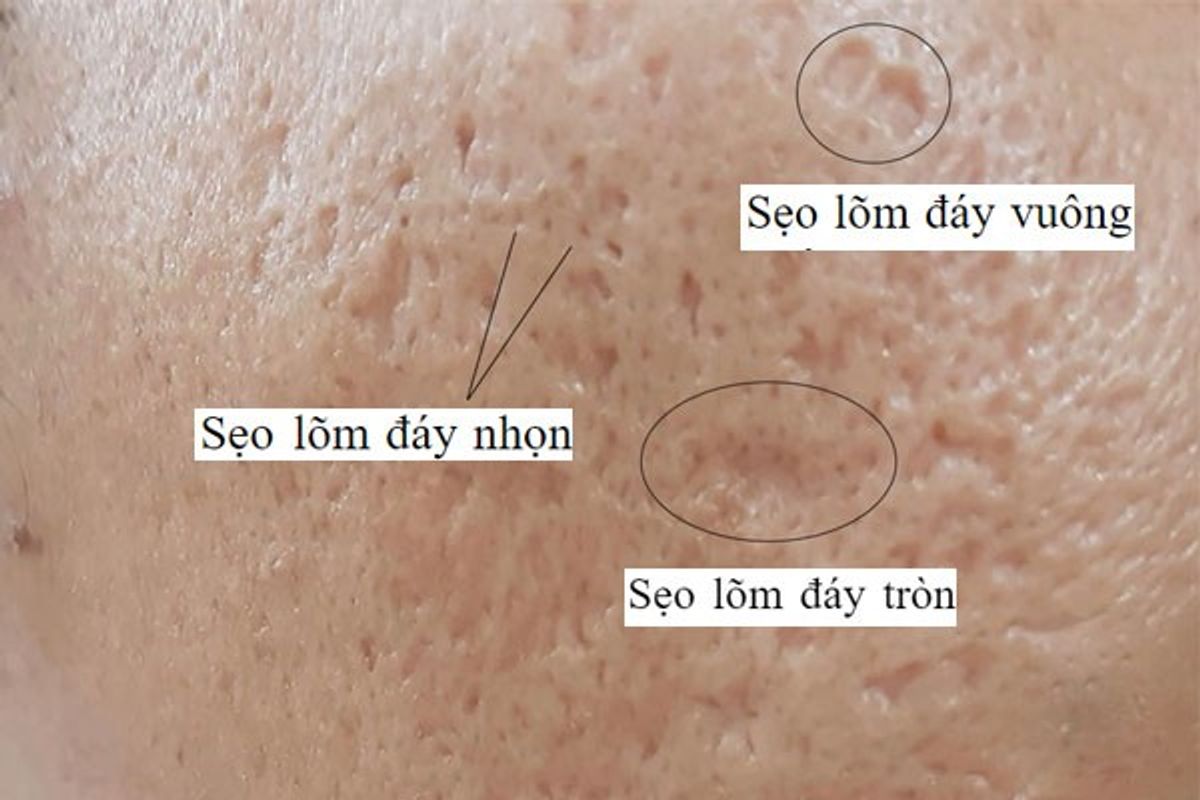 Sẹo rỗ lâu năm nhiều hình thái