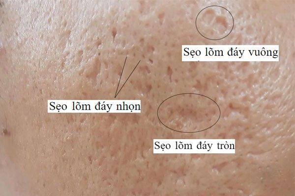 Sẹo rỗ lâu năm nhiều hình thái